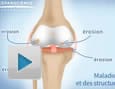 Comprendre l'arthrose