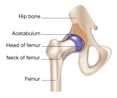 osteoarthitis of the hip