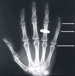 Arthrose main symptômes : Douleur articulaire main, nodosités de ...