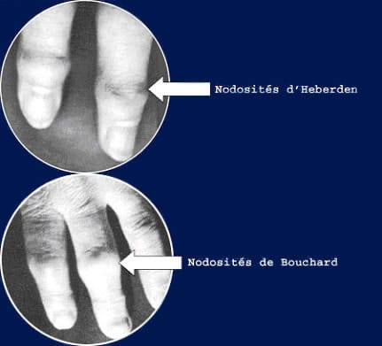 bouchard's nodes