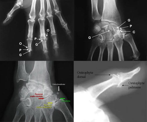 Image: Radiographie du genou dans l'arthrose - Édition professionnelle du  Manuel MSD
