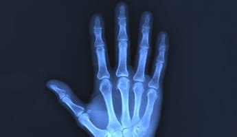 prevenir la osteoartritis de los dedos