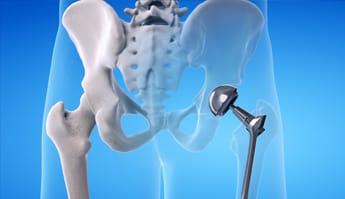 una prótesis de cadera por osteoartritis
