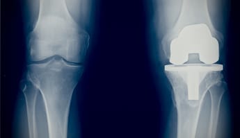 a knee prosthesis because of osteoarthritis