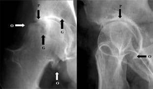 Radio d'arthrose de la hanche (coxarthrose)
