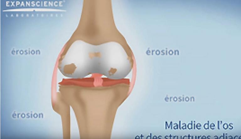 C'est de l'arthrose docteur ? Ai-je de l'arthrose ?