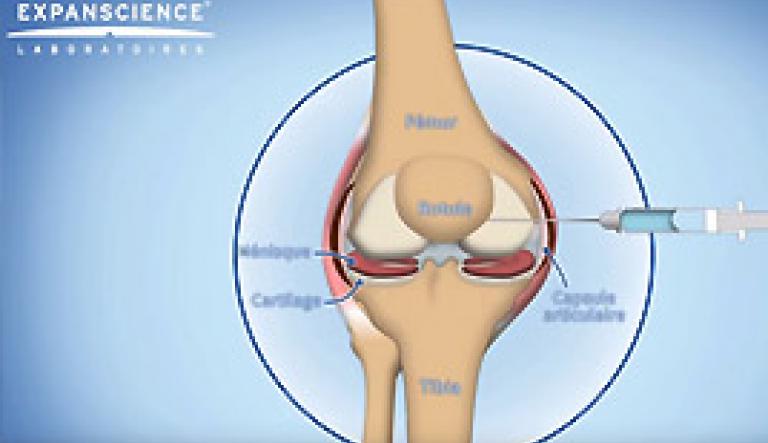 Infiltration, viscosupplémentation traitement Arthrose genou