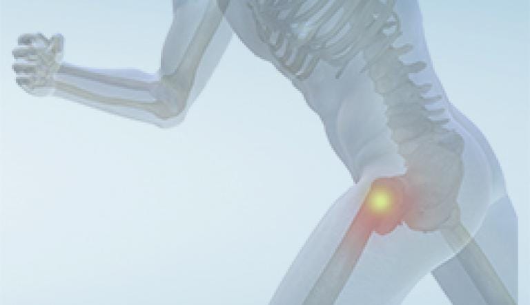 Les symptômes de l'arthrose de la hanche ou du genou