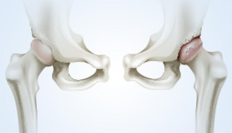 La Osteoartritis: Evolución