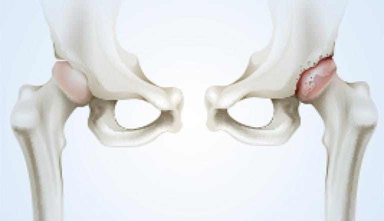 How does osteoarthritis evolve