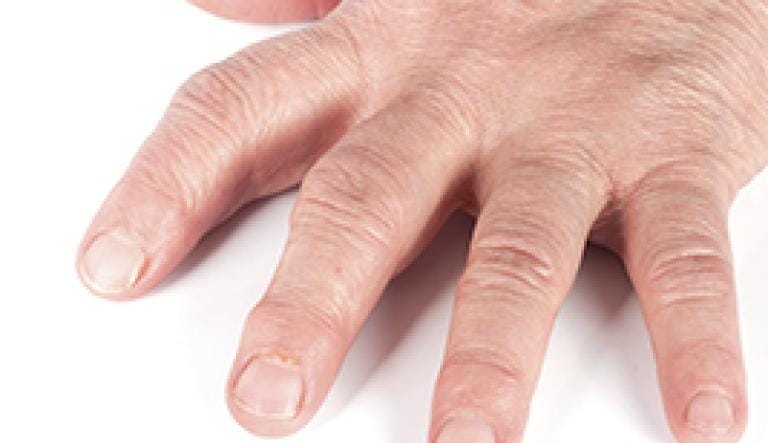 La poliartritis reumatoide