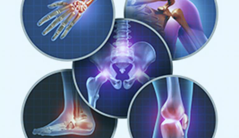 La Osteoartritis y los síntomas