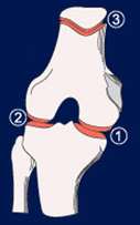 Type de gonarthrose - Arthrose fémoro-tibiale interne ou Arthrose fémoro-tibiale externe ou Arthrose fémoro-patellaire