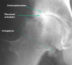 arthrose radiographie