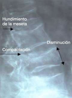 Fig 4 : Aspectos de fracturas-asientos vertebrales osteoporosis sobre un rachis