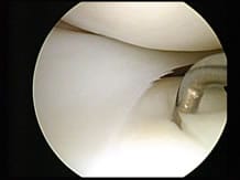 arthroscopy