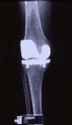 Prothèse articulaire genou tricompartimentale