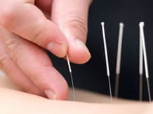 acupuncture