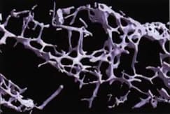 Fig 2 : Schéma représentant une ostéoporose importante. Au cours de l'ostéoporose, on observe des perforations des travées et des bouleversements de la micro-architecture osseuse trabéculaire qui constituent la fragilité osseuse.