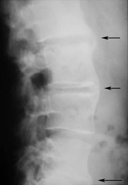 espondiloartritis radiografía dorso lumbar