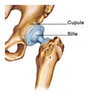 prothèse de hanche
