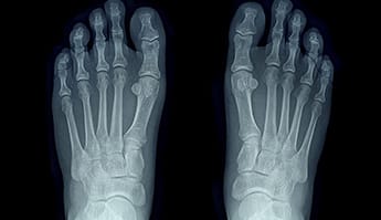 radios arthrosis feet ankles