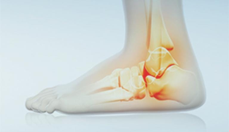 Ankle osteoarthritis : dolor