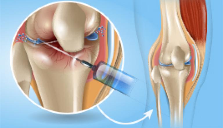 La viscosupplémentation ou injection d'acide hyaluronique